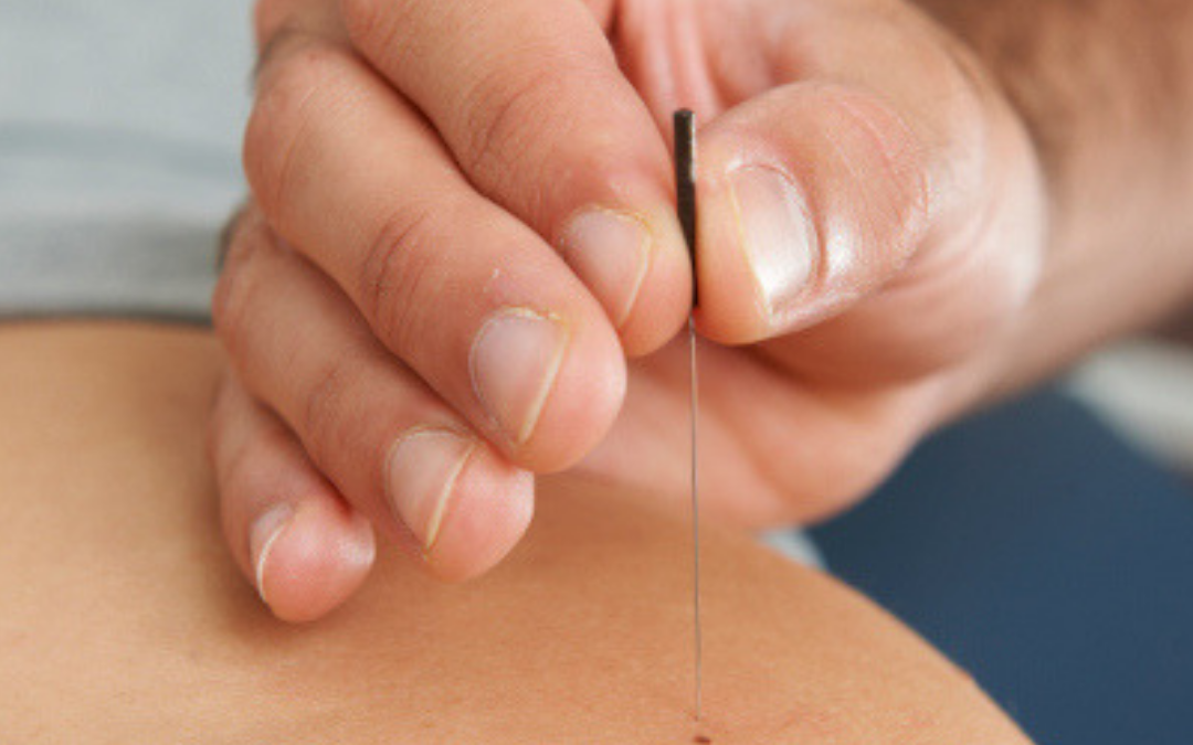 Dry Needling for Myofascial Pain and Dysfunction