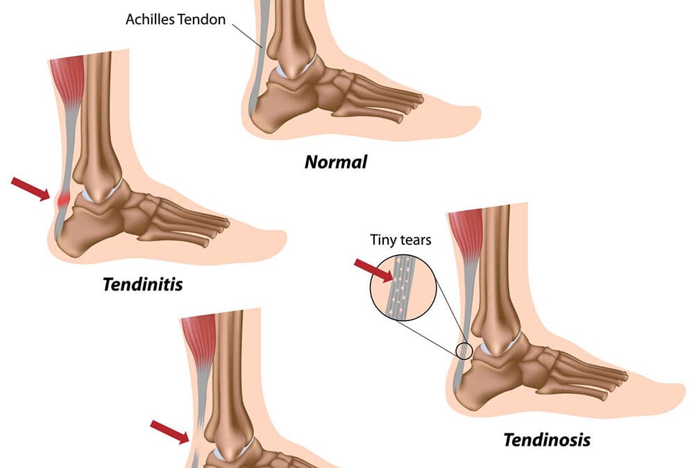 Achilles Tendinitis and the Role of Sports Massage in Rehabilitation