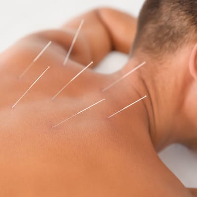 Dry Needling for Runners: A Promising Therapy for Performance and Recovery